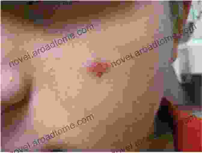 Honey For Skin Lesions How To Kill Genital Warts And Skin Lesions For Under $20