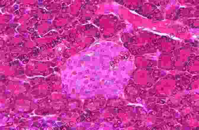 Microphotograph Of Inflammatory Cells In The Pancreas An Herbalist S Guide To Reversing Diabetes: Navigating Conflicting Information About Diabetes Type 2 And Healthy Eating