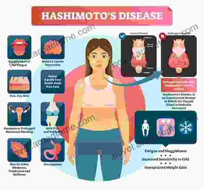 Smiling Woman Embracing Health With Hashimoto Disease Live Healthy With Hashimoto S Disease: The Natural Ayurvedic Approach To Managing Your Autoimmune DisFree Download